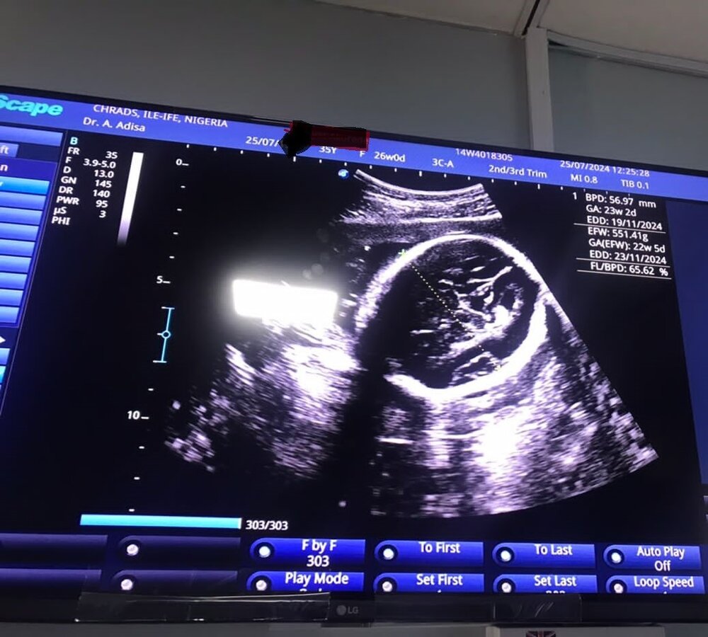Ultrasound Scan 1
